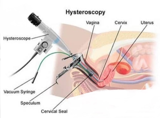 هیستروسکوپی